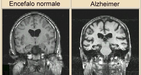 Alzheimer